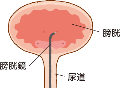 ボツリヌス療法のイラスト画像