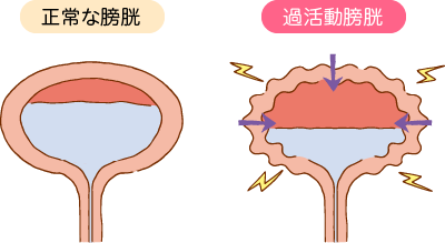 正常な膀胱と過活動膀胱のイラスト画像