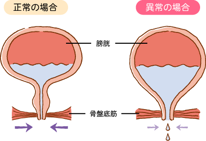 過活動膀胱が発症するしくみのイラスト画像