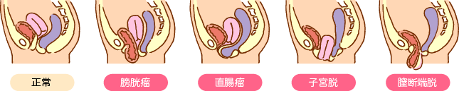 骨盤臓器脱のイラスト画像