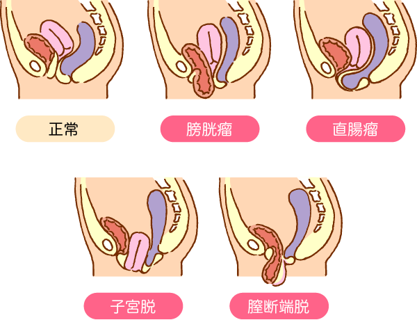 骨盤臓器脱のイラスト画像