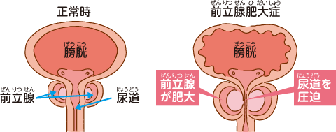 前立腺のイラスト画像