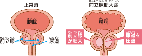 前立腺のイラスト画像